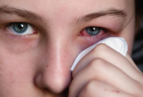 Allergie oculaire :symptômes, principales causes, que faire ?
