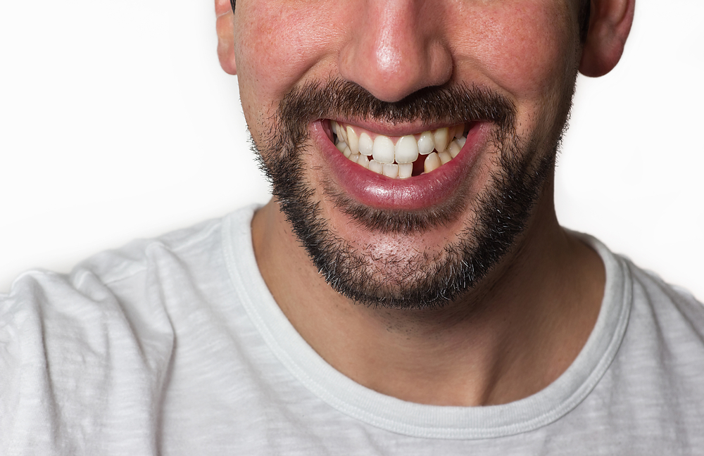 Pourquoi les dents manquantes doivent-elles être remplacées et les espaces entre les dents comblés ?